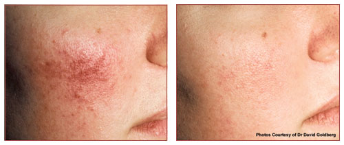 bna-rosacea-vbeam